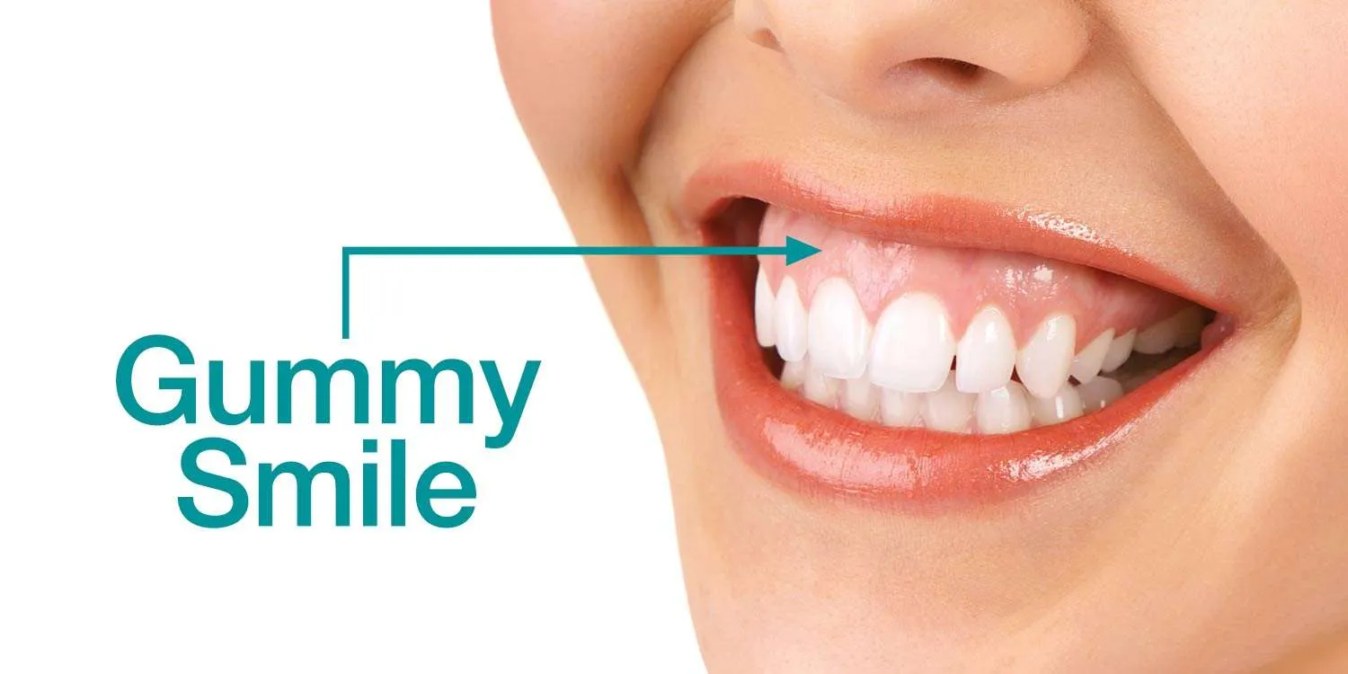 gummy-smile